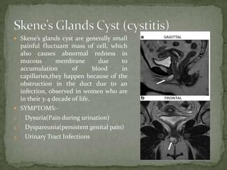 glande de skene|Skene’s Gland Cyst: Causes, Symptoms & Treatment